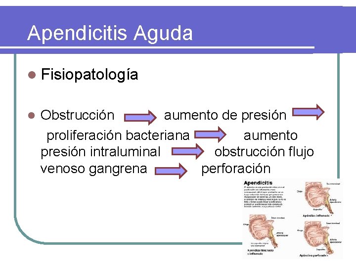Apendicitis Aguda l Fisiopatología l Obstrucción aumento de presión proliferación bacteriana aumento presión intraluminal