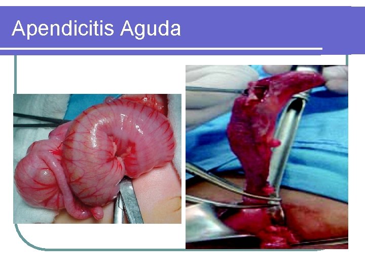 Apendicitis Aguda 