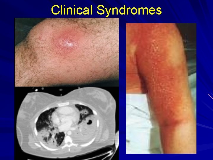 Clinical Syndromes 