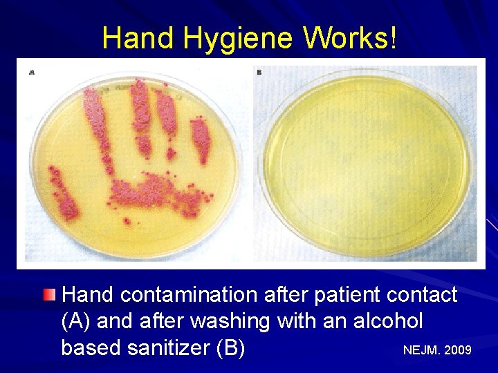 Hand Hygiene Works! Hand contamination after patient contact (A) and after washing with an