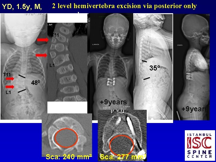 YD, 1. 5 y, M, 2 level hemivertebra excision via posterior only approach 35°