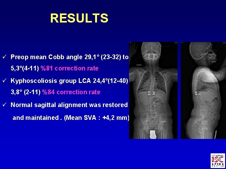 RESULTS ü Preop mean Cobb angle 29, 1° (23 -32) to 5, 3°(4 -11)