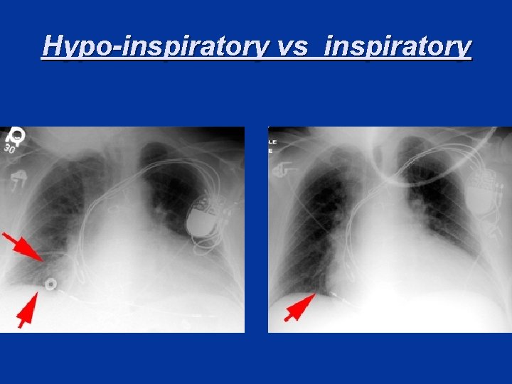 Hypo-inspiratory vs inspiratory 