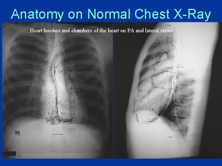 Anatomy on Normal Chest X-Ray Heart borders and chambers of the heart on PA