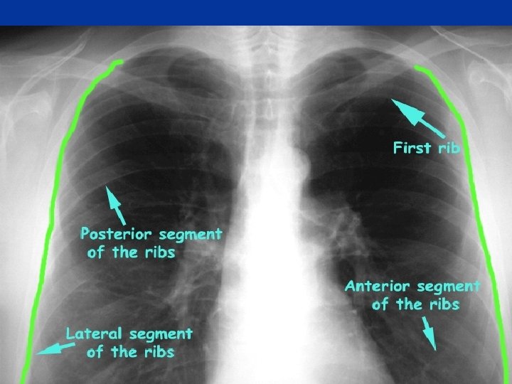 Frontal Chest X-Ray 