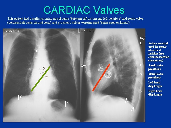 CARDIAC Valves This patient had a malfunctioning mitral valve (between left atrium and left