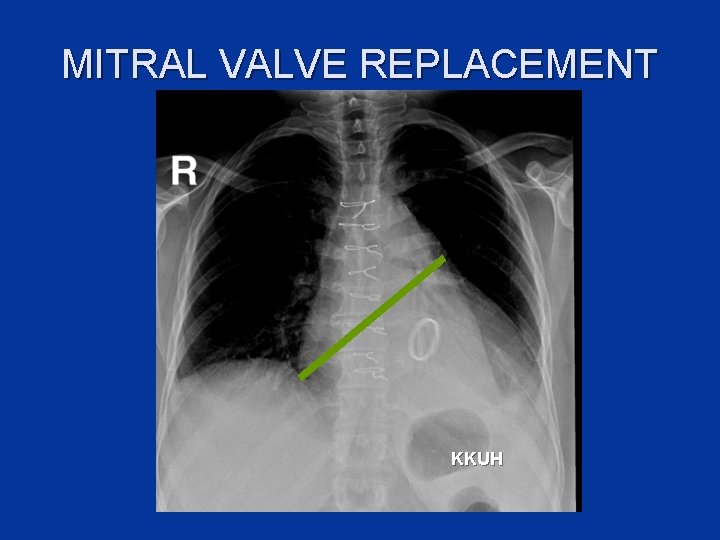 MITRAL VALVE REPLACEMENT KKUH 