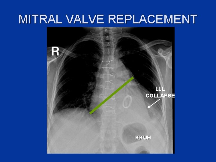 MITRAL VALVE REPLACEMENT LLL COLLAPSE KKUH 