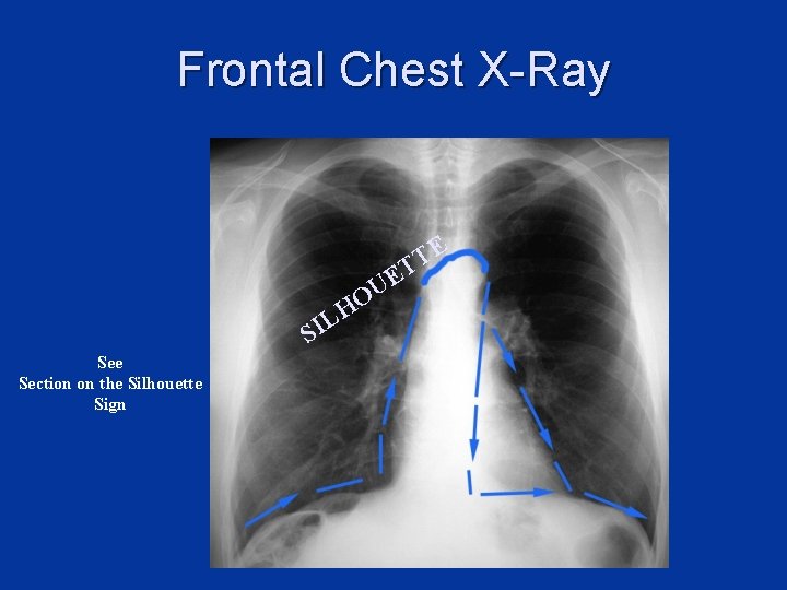 Frontal Chest X-Ray E T T L E U HO SI See Section on