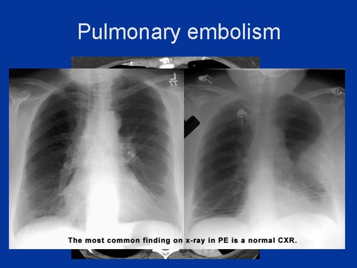 Pulmonary embolism 