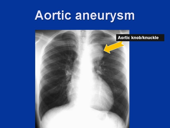 Aortic aneurysm Aortic knob/knuckle 