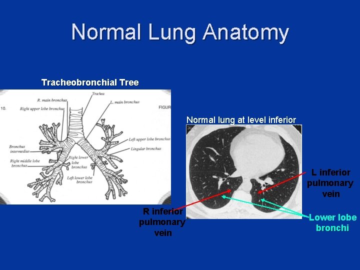 Normal Lung Anatomy Tracheobronchial Tree Normal lung at level inferior pulmonary veins L inferior