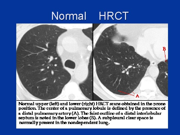 Normal HRCT 