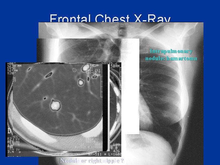 Frontal Chest X-Ray Intrapulmonary nodule: hamartoma Nodule or right nipple ? 