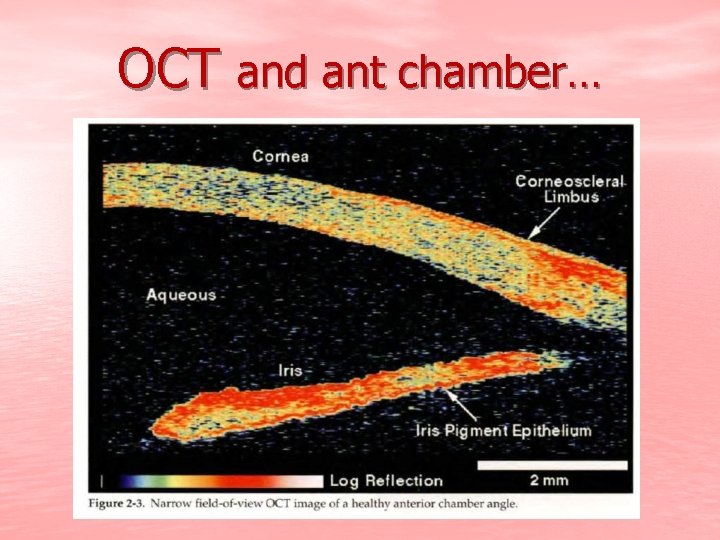 OCT and ant chamber… 