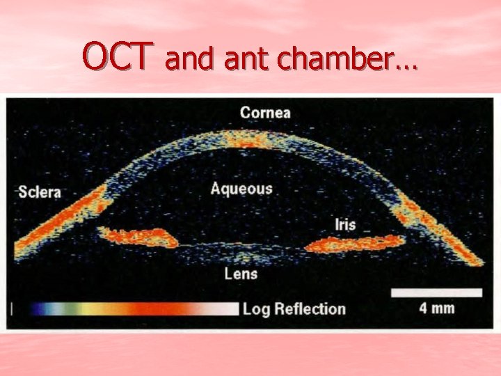 OCT and ant chamber… 