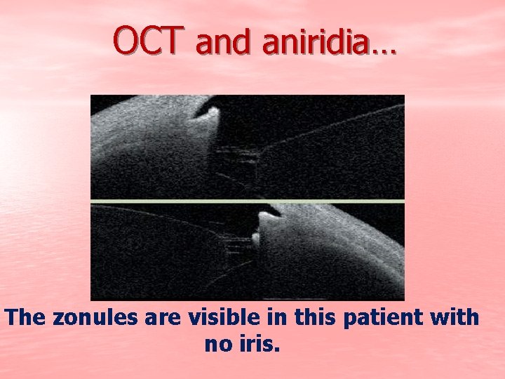 OCT and aniridia… The zonules are visible in this patient with no iris. 