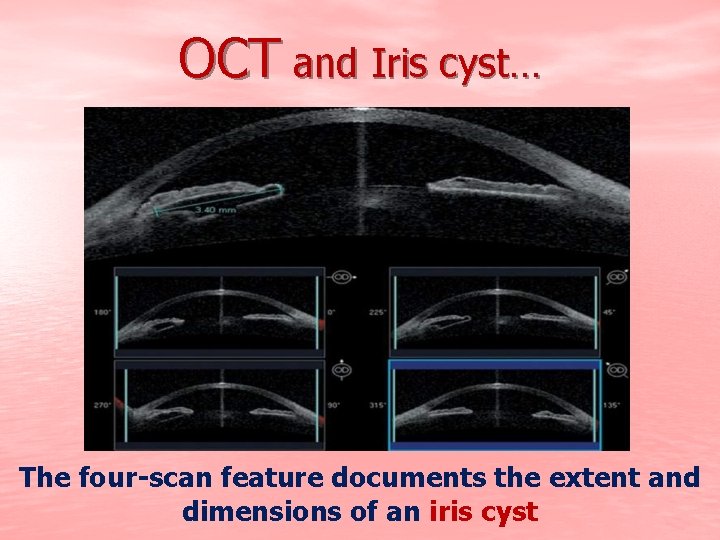 OCT and Iris cyst… The four-scan feature documents the extent and dimensions of an