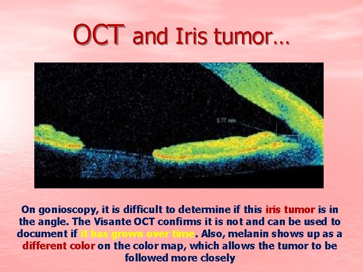 OCT and Iris tumor… On gonioscopy, it is difficult to determine if this iris