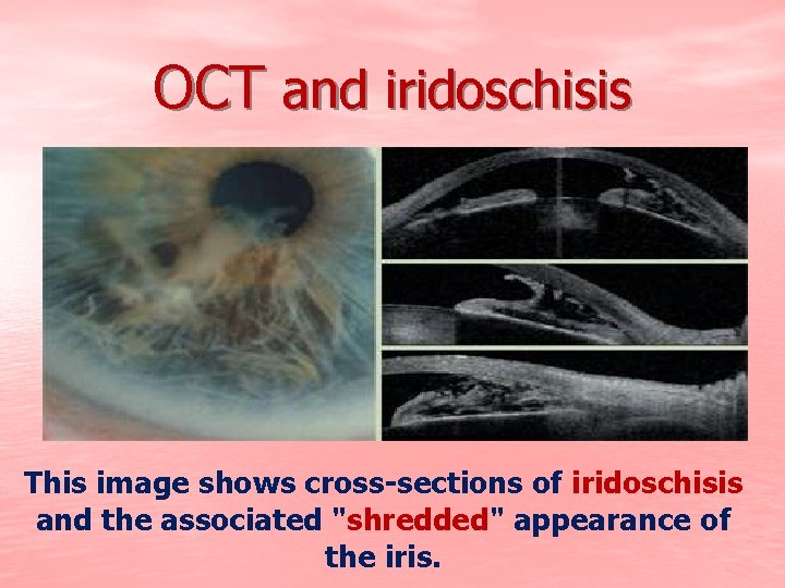 OCT and iridoschisis This image shows cross-sections of iridoschisis and the associated "shredded" appearance