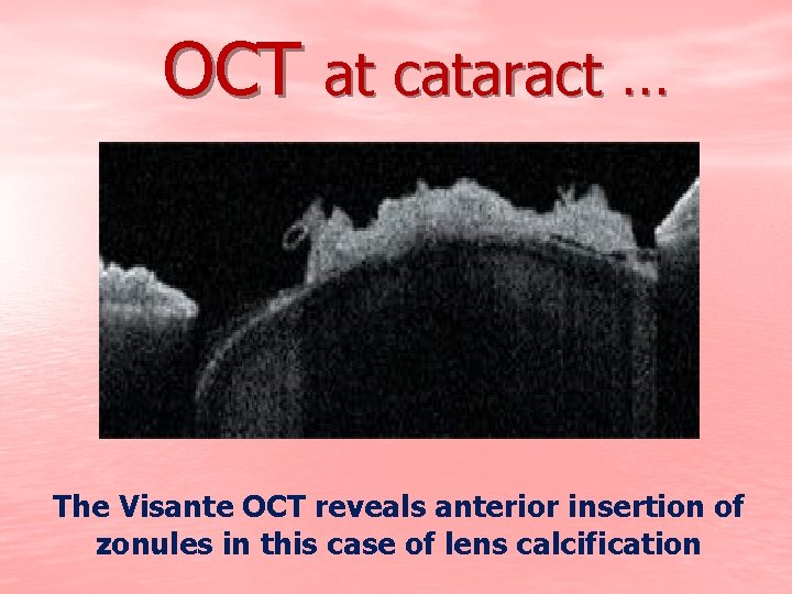 OCT at cataract … The Visante OCT reveals anterior insertion of zonules in this