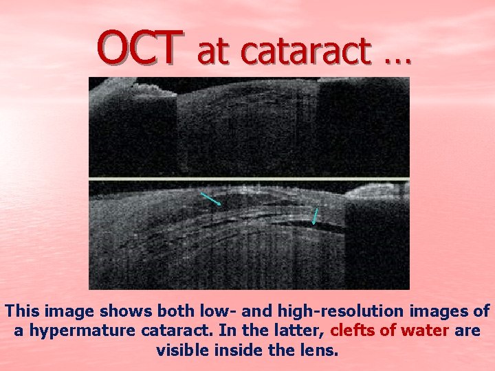 OCT at cataract … This image shows both low- and high-resolution images of a