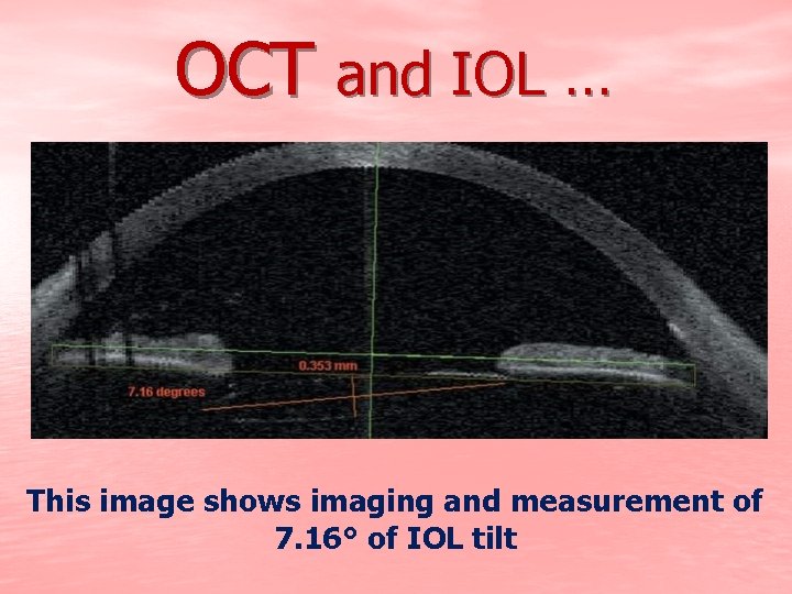 OCT and IOL … This image shows imaging and measurement of 7. 16° of