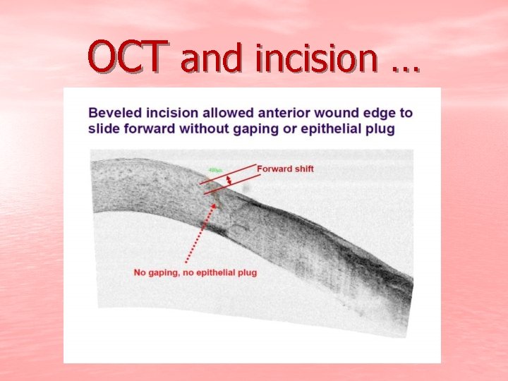 OCT and incision … 