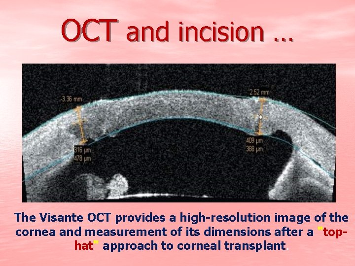 OCT and incision … The Visante OCT provides a high-resolution image of the cornea