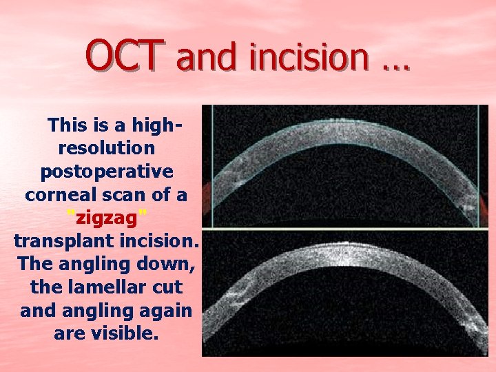 OCT and incision … This is a highresolution postoperative corneal scan of a "zigzag"