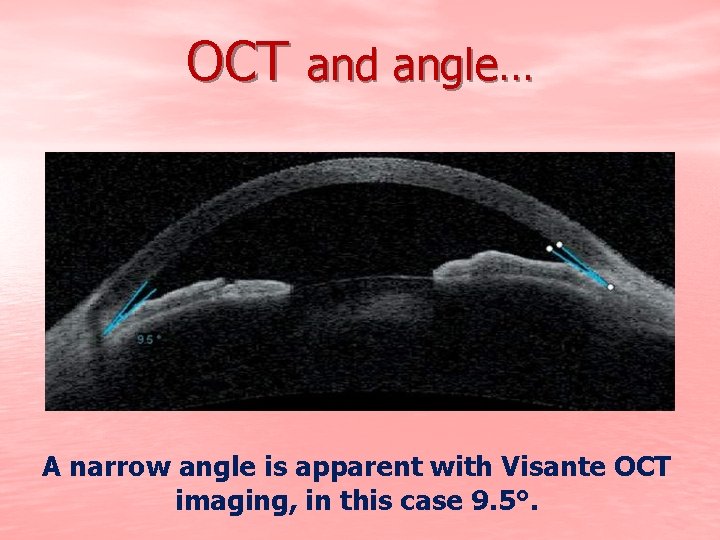 OCT and angle… A narrow angle is apparent with Visante OCT imaging, in this