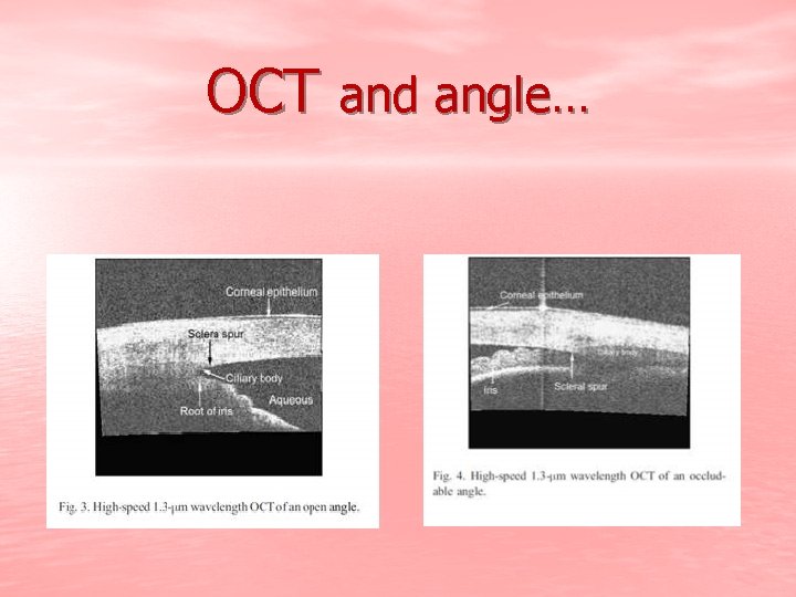 OCT and angle… 