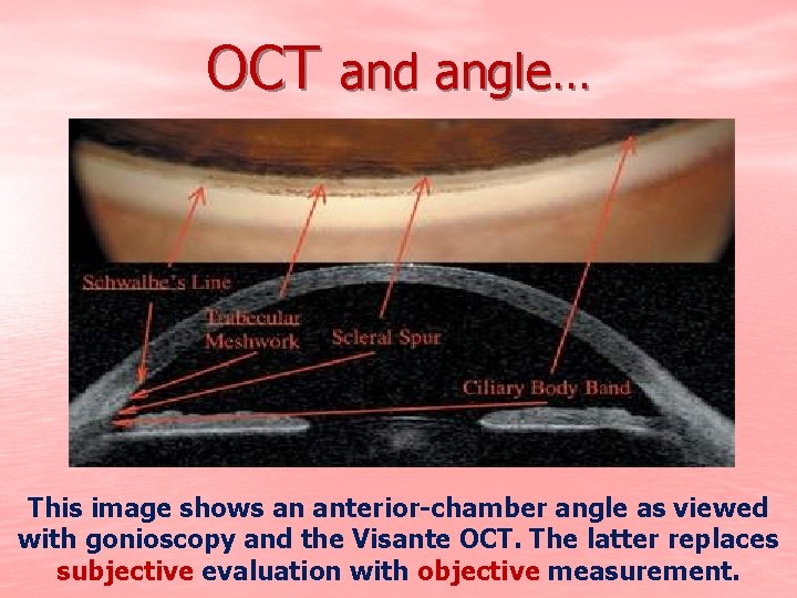OCT and angle… This image shows an anterior-chamber angle as viewed with gonioscopy and