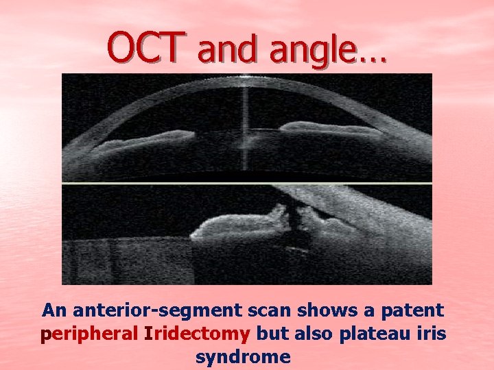 OCT and angle… An anterior-segment scan shows a patent peripheral Iridectomy but also plateau