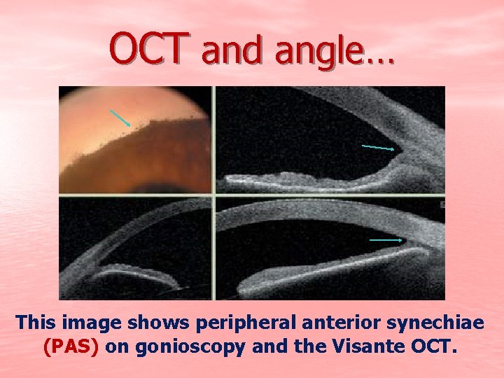 OCT and angle… This image shows peripheral anterior synechiae (PAS) on gonioscopy and the