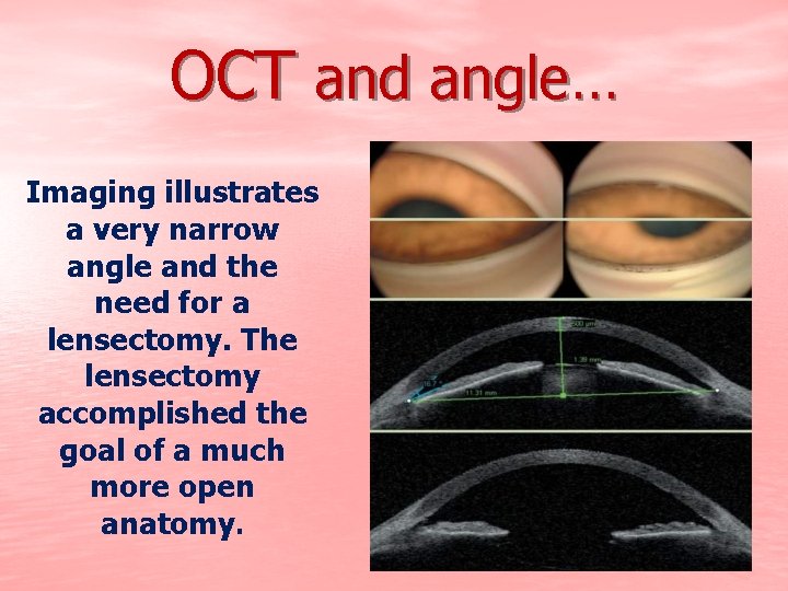 OCT and angle… Imaging illustrates a very narrow angle and the need for a