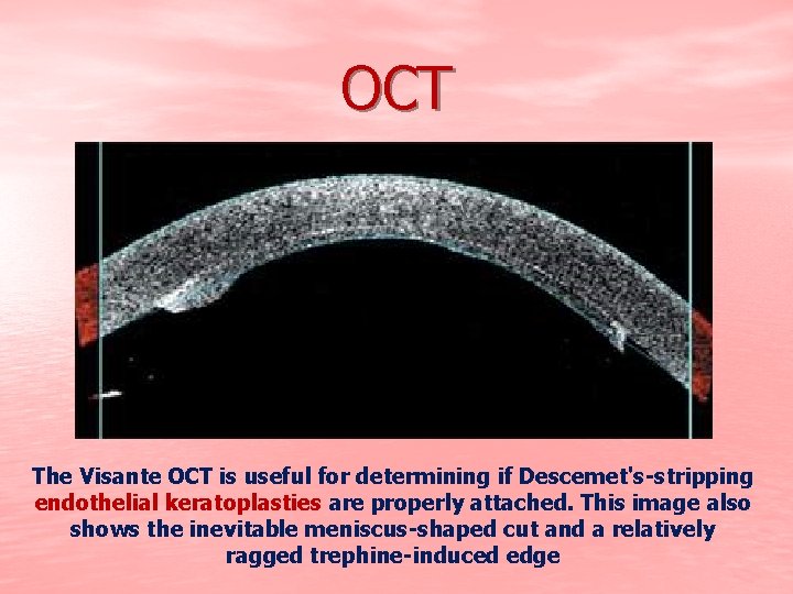 OCT The Visante OCT is useful for determining if Descemet's-stripping endothelial keratoplasties are properly