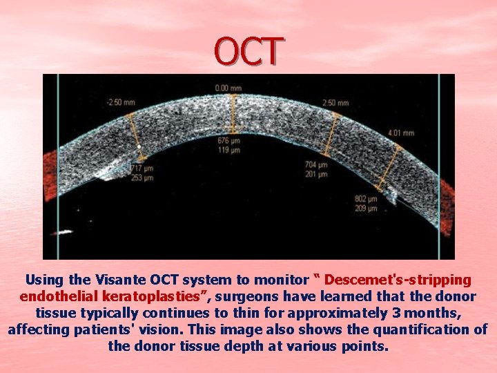 OCT Using the Visante OCT system to monitor “ Descemet's-stripping endothelial keratoplasties”, surgeons have