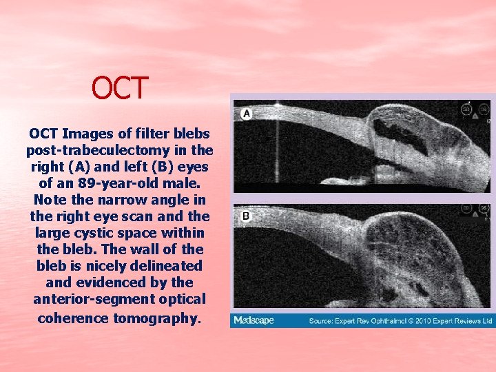 OCT Images of filter blebs post-trabeculectomy in the right (A) and left (B) eyes