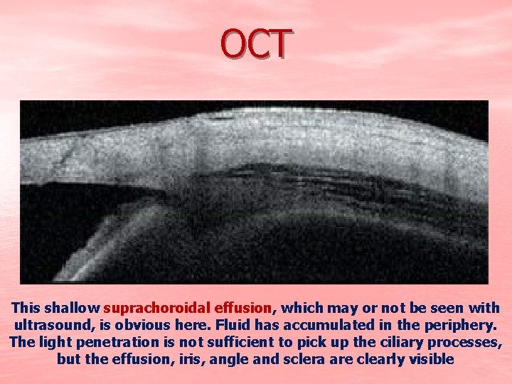 OCT This shallow suprachoroidal effusion, which may or not be seen with ultrasound, is