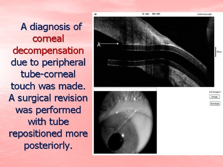 A diagnosis of corneal decompensation due to peripheral tube-corneal touch was made. A surgical