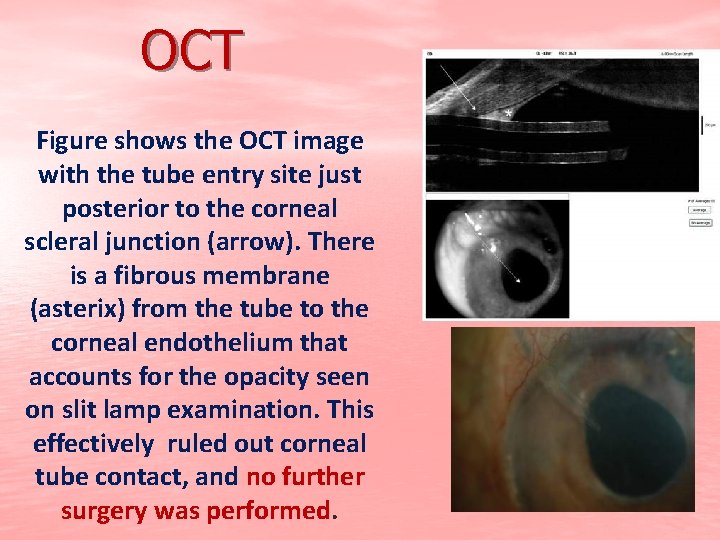 OCT Figure shows the OCT image with the tube entry site just posterior to