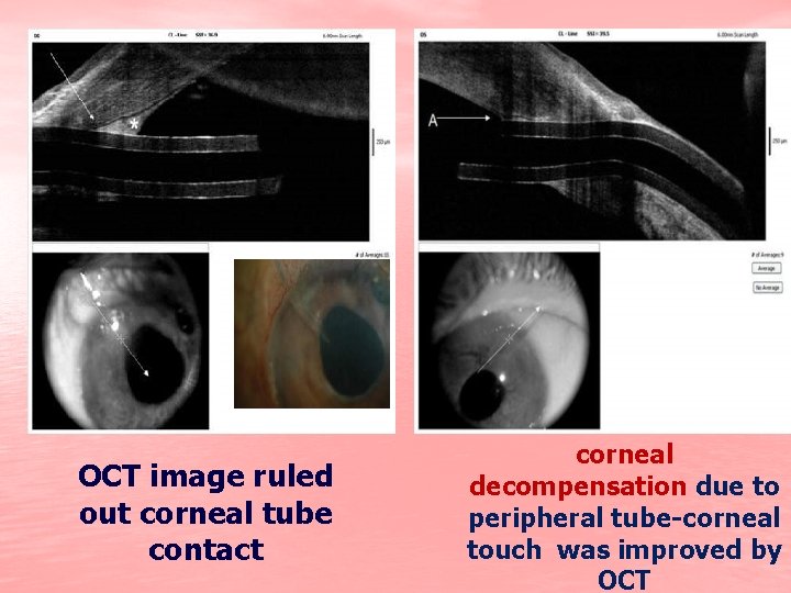 OCT image ruled out corneal tube contact corneal decompensation due to peripheral tube-corneal touch