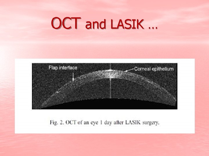 OCT and LASIK … 