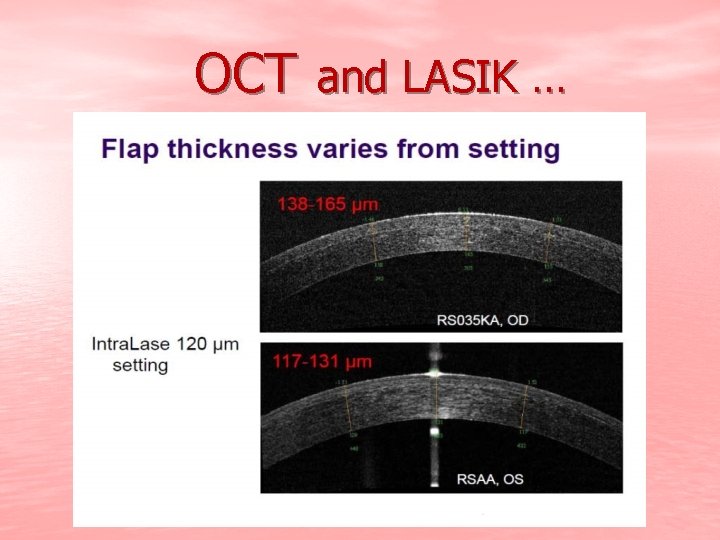 OCT and LASIK … 