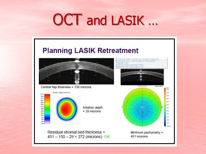 OCT and LASIK … 