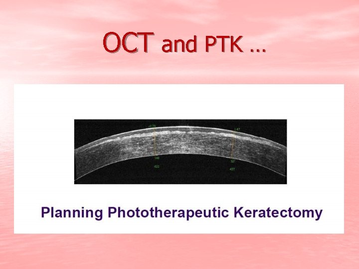 OCT and PTK … 