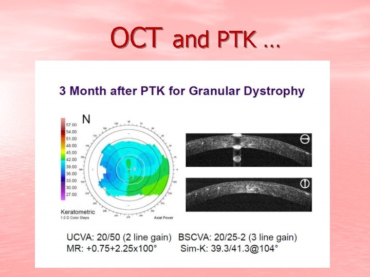 OCT and PTK … 
