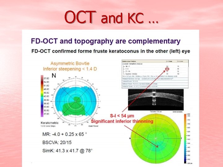 OCT and KC … 