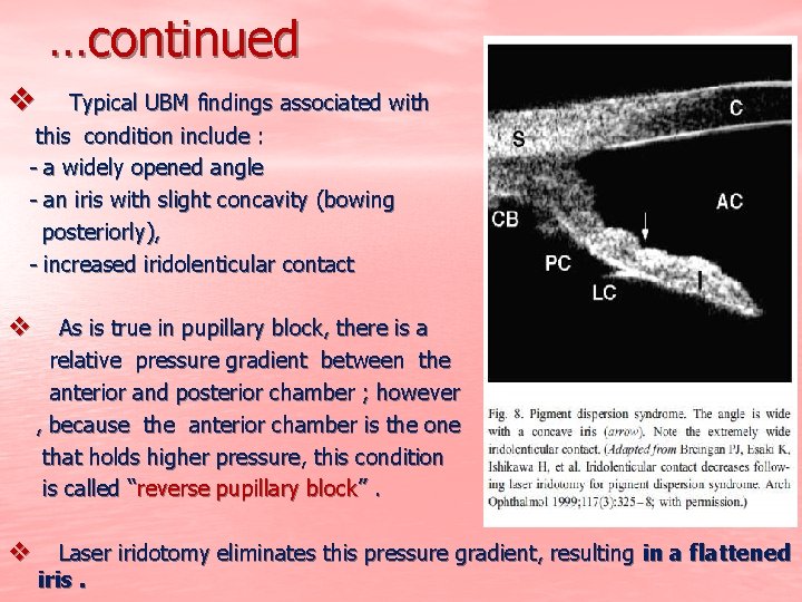 …continued v Typical UBM findings associated with this condition include : - a widely